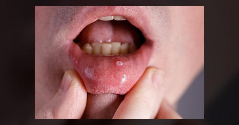 <p>Management of Mucous Cyst</p>