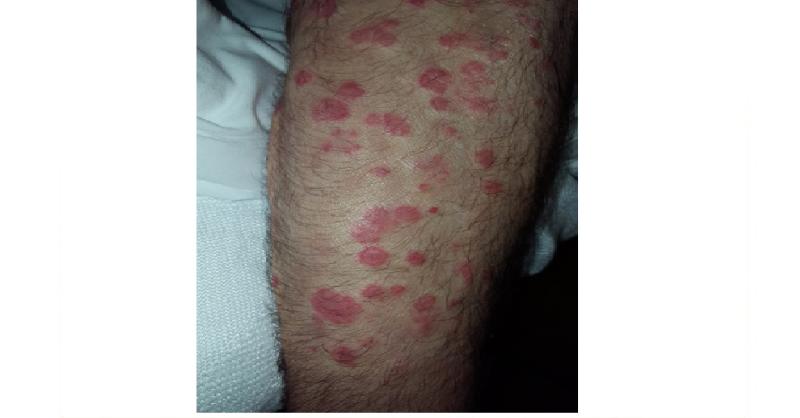 <p>How would you treat Annular erythema?</p>