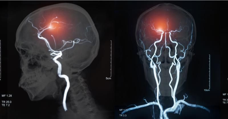 CT and MRI in the Preoperative Evaluation of Internal Carotid Artery Encasement 