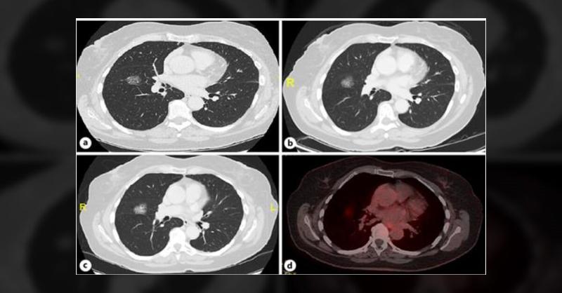 A Case Study on Primary Pulmonary MALT Lymphoma Treated with Radiation Therapy