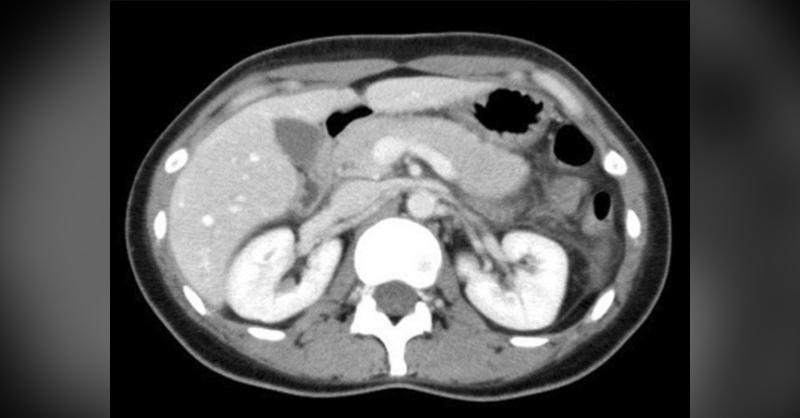 A 31-year-old woman with Fulminant Type 1 Diabetes Mellitus 