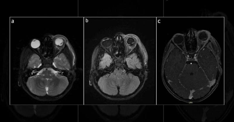 <p>Intricate Ocular Trauma: Surgical Exploration and Retinal Repair</p>