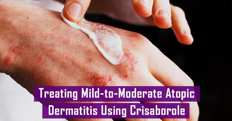 <p>Your Opinion on Crisaborole as an Effective Treatment for Mild-to-Moderate Atopic Dermatitis</p>