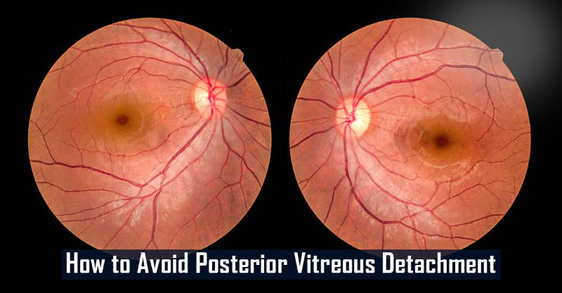 Prevention of Posterior vitreous detachment