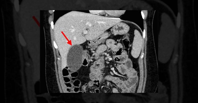 <p>Management of Gallbladder Dysfunction and Choledocholithiasis in a Young Adult</p>