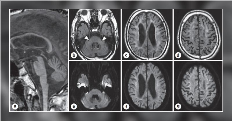 <p>A Case of Tremor and Cognitive Impairment in the Elderly: Identify the Rare Neurodegenerative Disorder in an Elderly</p>
