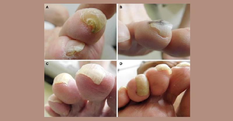 Diagnose this Nail Lesion
