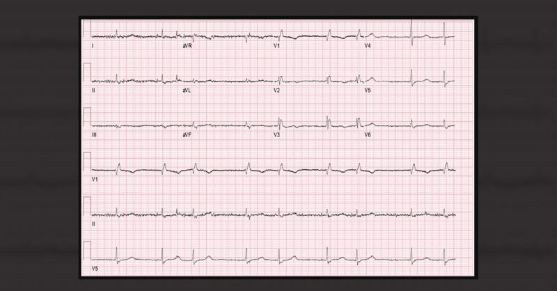 <p>What could be the underlying cause of the patient's Hypotension, Bradycardia, and Hypothermia?</p>