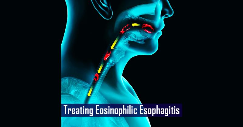 Evidence-Based Treatment Strategies for Eosinophilic Esophagitis