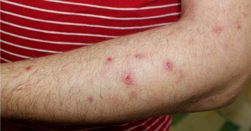 <p>Immunotargets and Therapy for Prurigo Nodularis</p>