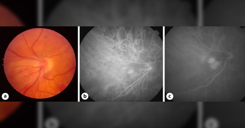 Retinal Capillary Hemangioma in a 36-year-old woman with Von Hippel-Lindau Disease