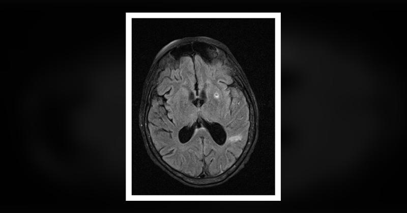 <p>Navigating the Complexities of Streptococcal Endocarditis</p>