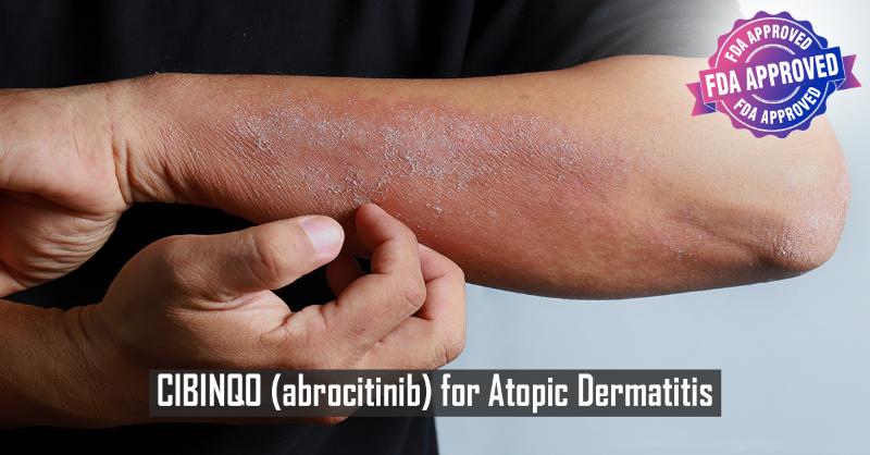 Abrocitinib for Adults with Moderate-to-Severe Atopic Dermatitis