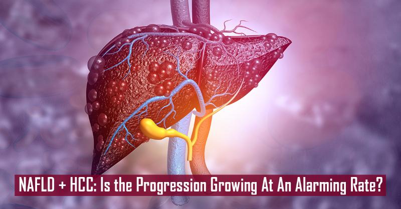 What are The Chances of Non-Alcoholic Fatty Liver Disease Transforming into Hepatocellular Carcinoma?
