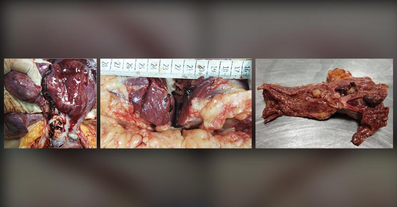 Autopsy and Medicolegal Evaluation in a Case of Sudden Maternal Death from Pulmonary Embolism