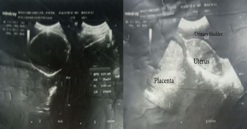 Advanced Abdominal Ectopic Pregnancy in a 26 year old woman