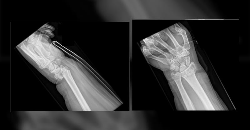 <p>The Post-traumatic Radioulnar Synostosis in a 57 year old Man</p>