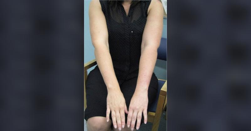 A Woman with a Swollen Arm Using an Oral Contraceptive