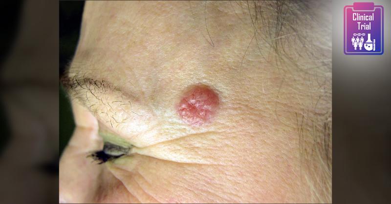 <p>Advanced Basal Cell Carcinoma treated with Vismodegib</p>