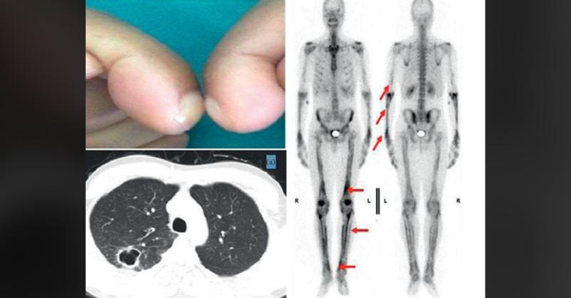 <p>A 36-year-old Man Presenting Bilateral Symmetric Polyarthralgia and Digital Clubbing</p>