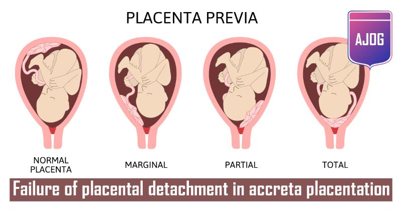 Placental Detachment in Accrete Placentation Associated with Fibrinoid Deposition at Utero-placental Interface