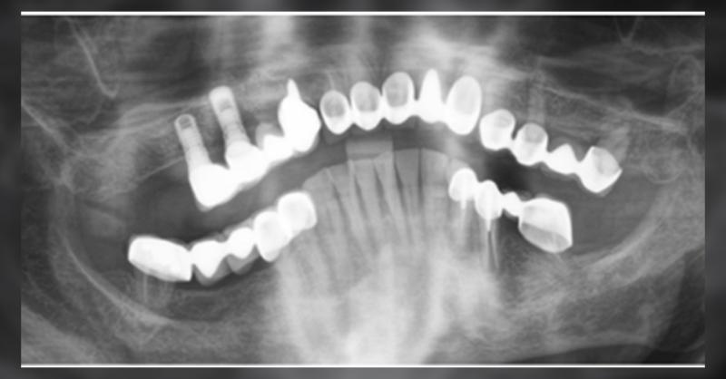 Treating a Small Bone Ridge of Prosthetic Rehabilitation in an Old ...
