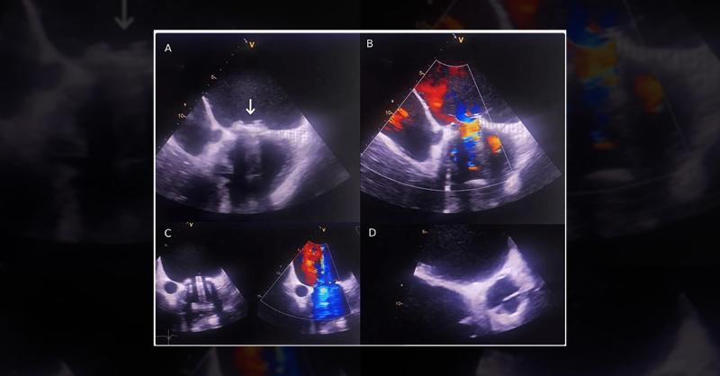 Prosthetic Valve Infective Endocarditis by Carbapenemase-Producing Klebsiella pneumoniae