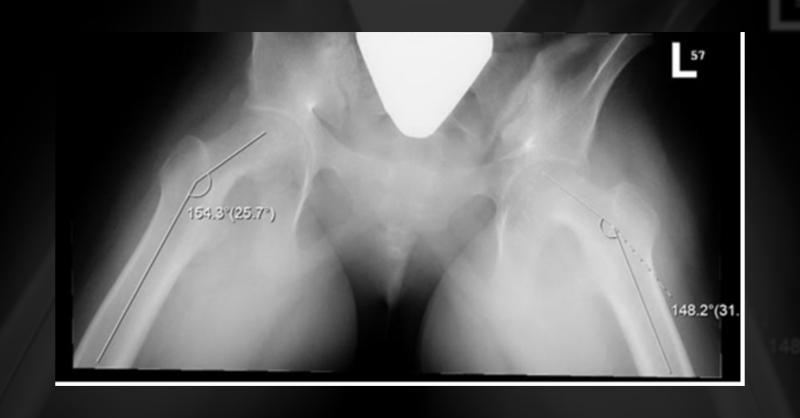Hip Dysfunction Unusual Presentation of Hip Dysfunction in an 11-Year-Old Girl | MedSynapse