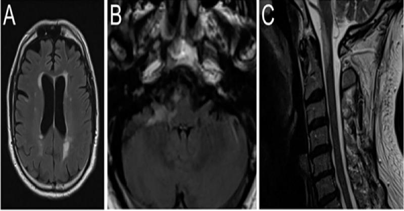 Multiple Neurological Complications After mRNA-Based COVID-19 Vaccine
