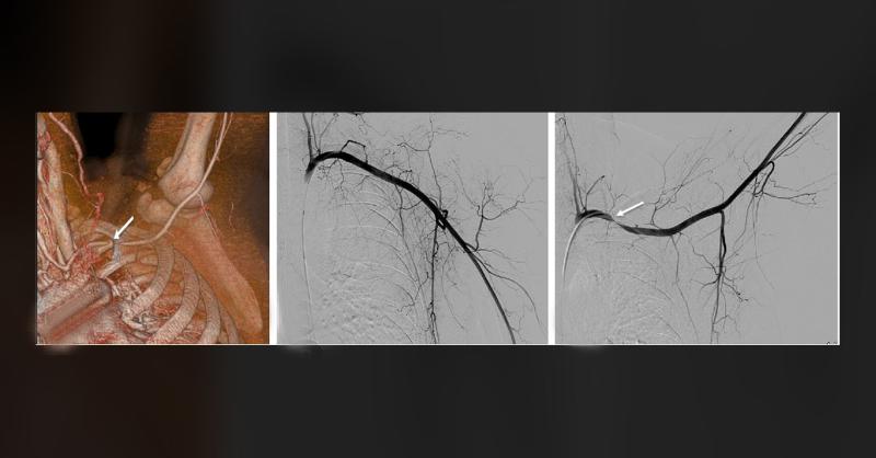 Traumatic Arterial TOS Involving the Mid-Thoracic Region