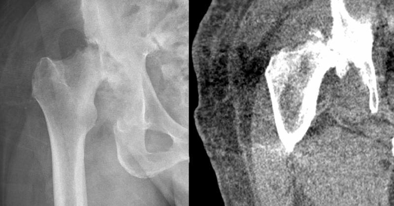 Early Diagnosis and Treatment Septic Arthritis