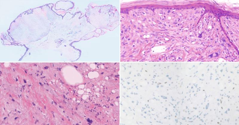Diagnose the Tumor Based on Histopathology