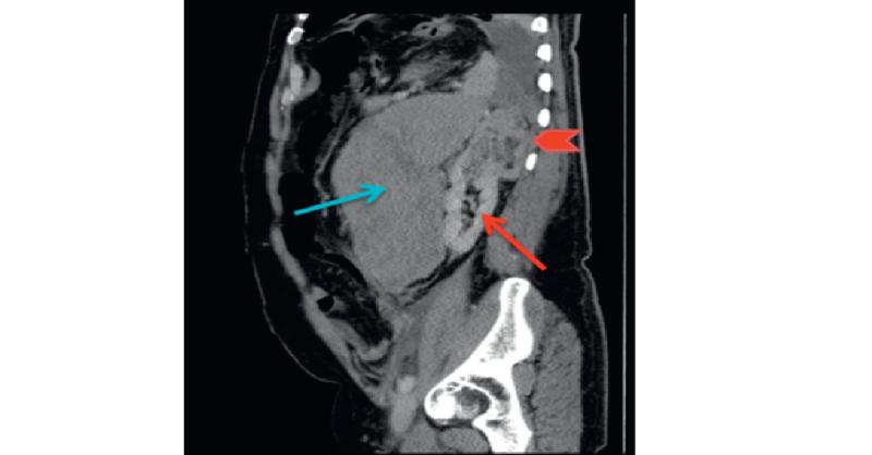 <p>Spontaneous Retroperitoneal Bleeding in 58-Year-Old Man</p>