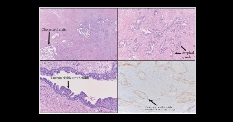 Diagnosis of Cystic Mass in Pelvic Area