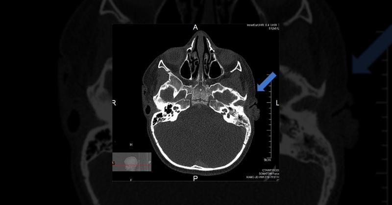 <p>Management of Foreign Body Complication in Middle Ear</p>