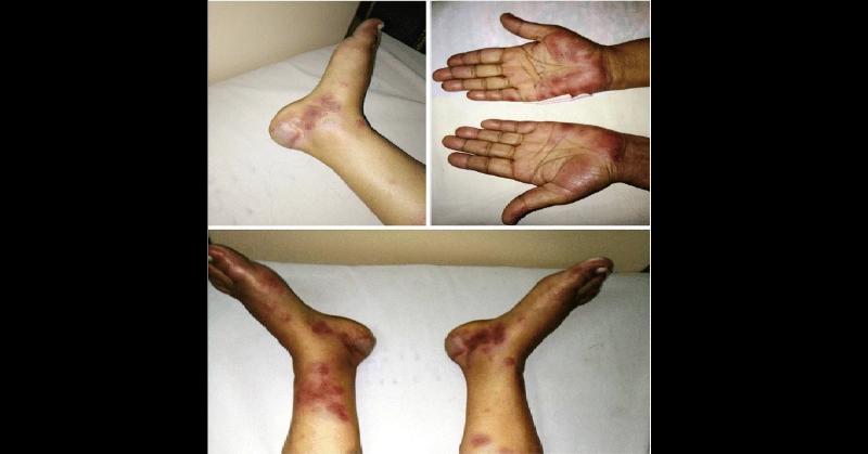 Fever and Extensive Purpuric Rash with Hemorrhage and Necrosis in a Previously Well 55-Year-Old Woman