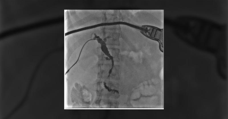 <p>Abdominal Pain and High-Grade Biliary Obstruction in a 36-Year-Old</p>