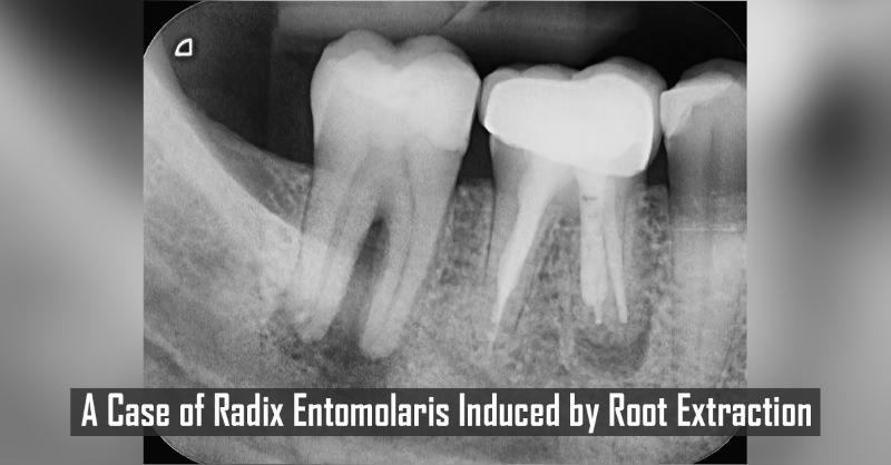 Unusual Case of a Second Mandibular Molar with A Radix Entomolaris