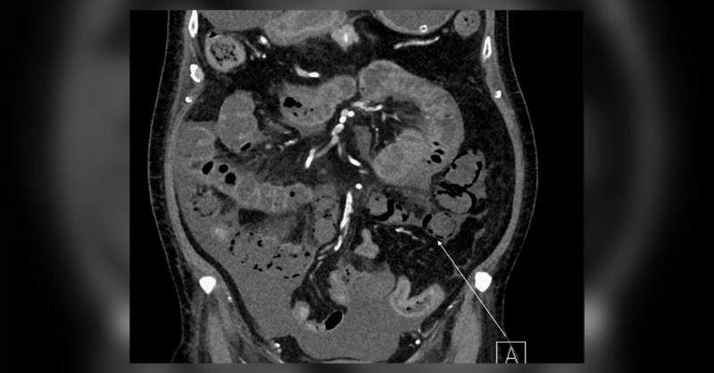 <p>Management of Acute Mesenteric Ischemia-Induced Septic Shock</p>