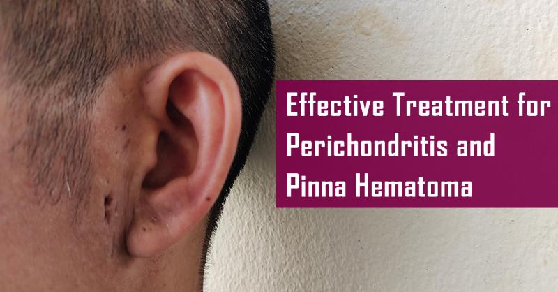 <p>An Effective Simple Treatment of Perichondritis and Haematoma of Pinna</p>