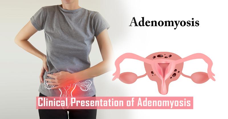Adenomyosis: Underlying Risk Factors, Evaluation, and Treatment