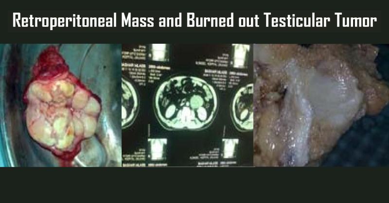 Retroperitoneal Mass and Burned out Testicular Tumor