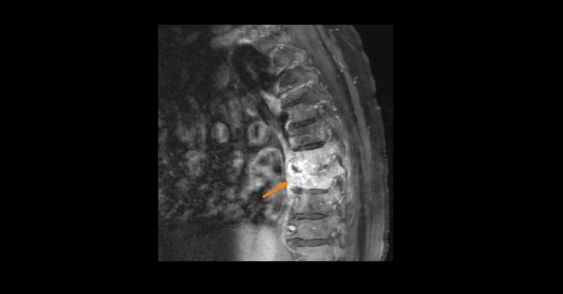 Your recommendations for treating vertebral osteomyelitis