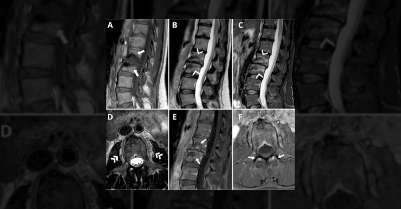 <p>Back Pain, Spine Edema, and Lesions - What Can Be The Patient’s Diagnosis</p>
