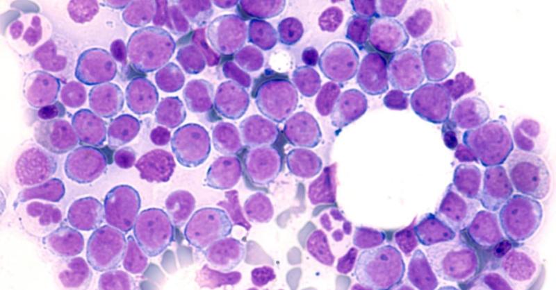 Insights into Managing Acute Myeloid Leukaemia