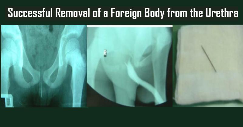 Successful Removal of a Foreign Body from the Urethra