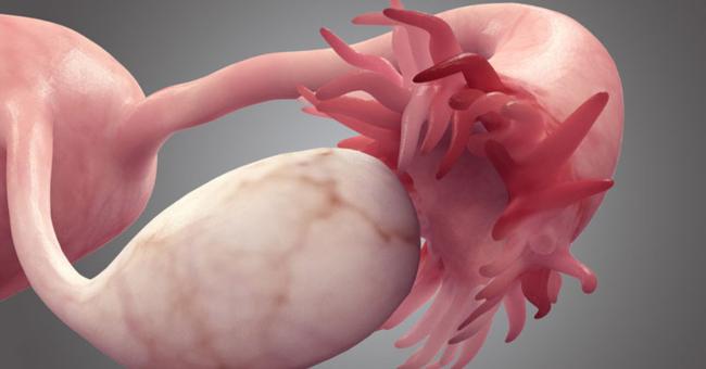 Chemo for Management of Ovarian Cancer