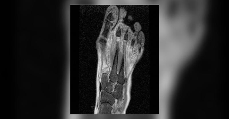 <p>Running Gone Wrong- Metatarsal Bilateral Stress Fracture in a Middle-Aged Woman</p>