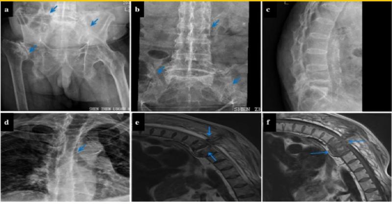 <p>Atraumatic Thoracic Spinal Fracture mimicking Herpes Zoster Neuralgia: A case report</p>