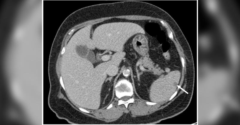 <p>A Rare Case of Microscopic Polyangiitis Presented with Splenic Infarction</p>